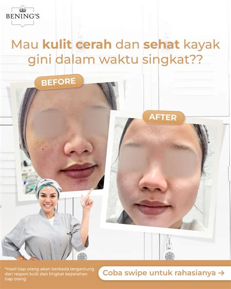 5 Keunggulan Laser di Benings Clinic untuk Kulit Lebih Cerah! 5 Keunggulan Laser di Benings Clinic untuk Kulit Lebih Cerah!