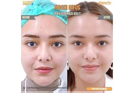 7 Cara Menghemat Hingga 50% Harga Perawatan Mochi Skin yang Wajib Kamu Coba! 7 Cara Menghemat Hingga 50% Harga Perawatan Mochi Skin yang Wajib Kamu Coba!