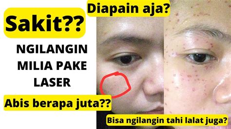 7 Fakta Mengejutkan Harga Laser CO2 di Larissa: Nomor 5 Bikin Dompet Nangis!