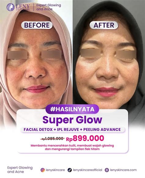 7 Harga Facial Leny Skincare: Rahasia Glowing Tanpa Bikin Kantong Bolong! 7 Harga Facial Leny Skincare: Rahasia Glowing Tanpa Bikin Kantong Bolong!