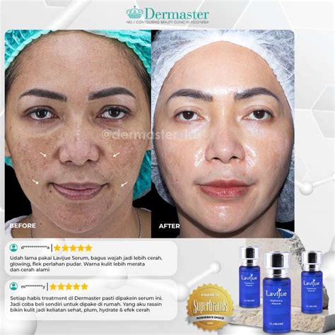 7 Perbandingan Harga Skincare Dermaster: Mana yang Paling Worth It?