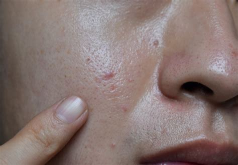 7 Rahasia Kulit Bebas Minyak: Bye-Bye Kilap, Hello Wajah Glowing!