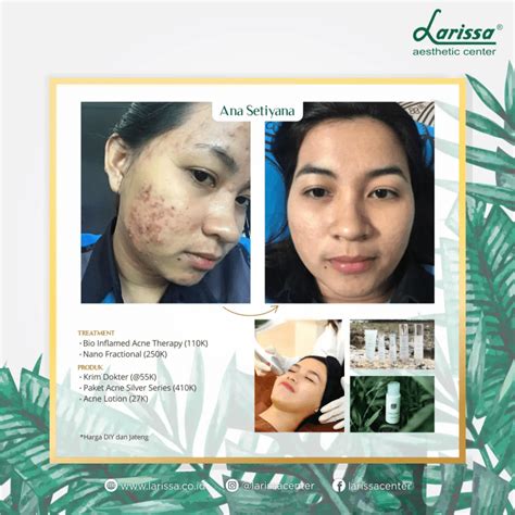 7 Treatment Larissa di Bawah 100 Ribu: Kantong Aman, Glowing Maksimal! 7 Treatment Larissa di Bawah 100 Ribu: Kantong Aman, Glowing Maksimal!