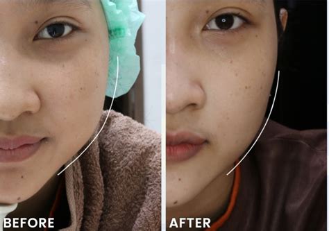 5 Rahasia Perawatan HIFU Agar Hasilnya 10X Lebih Cetar! 5 Rahasia Perawatan HIFU Agar Hasilnya 10X Lebih Cetar!