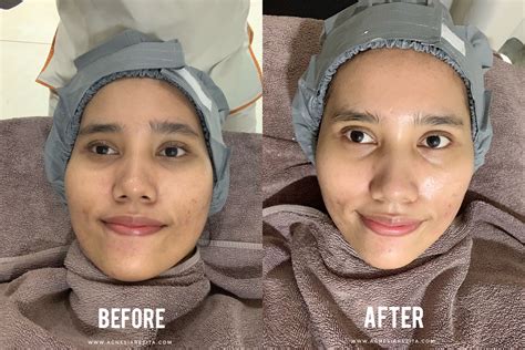 5 Rangkaian Perawatan Wajib di Erha Clinic untuk Kulit Glowing! 5 Rangkaian Perawatan Wajib di Erha Clinic untuk Kulit Glowing!